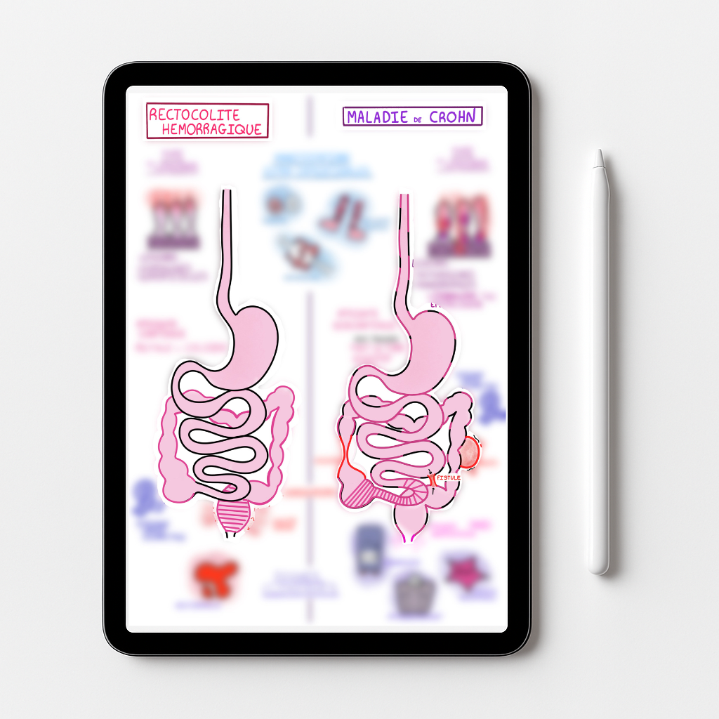 Les maladies inflammatoires chroniques de l'intestin (MICI)