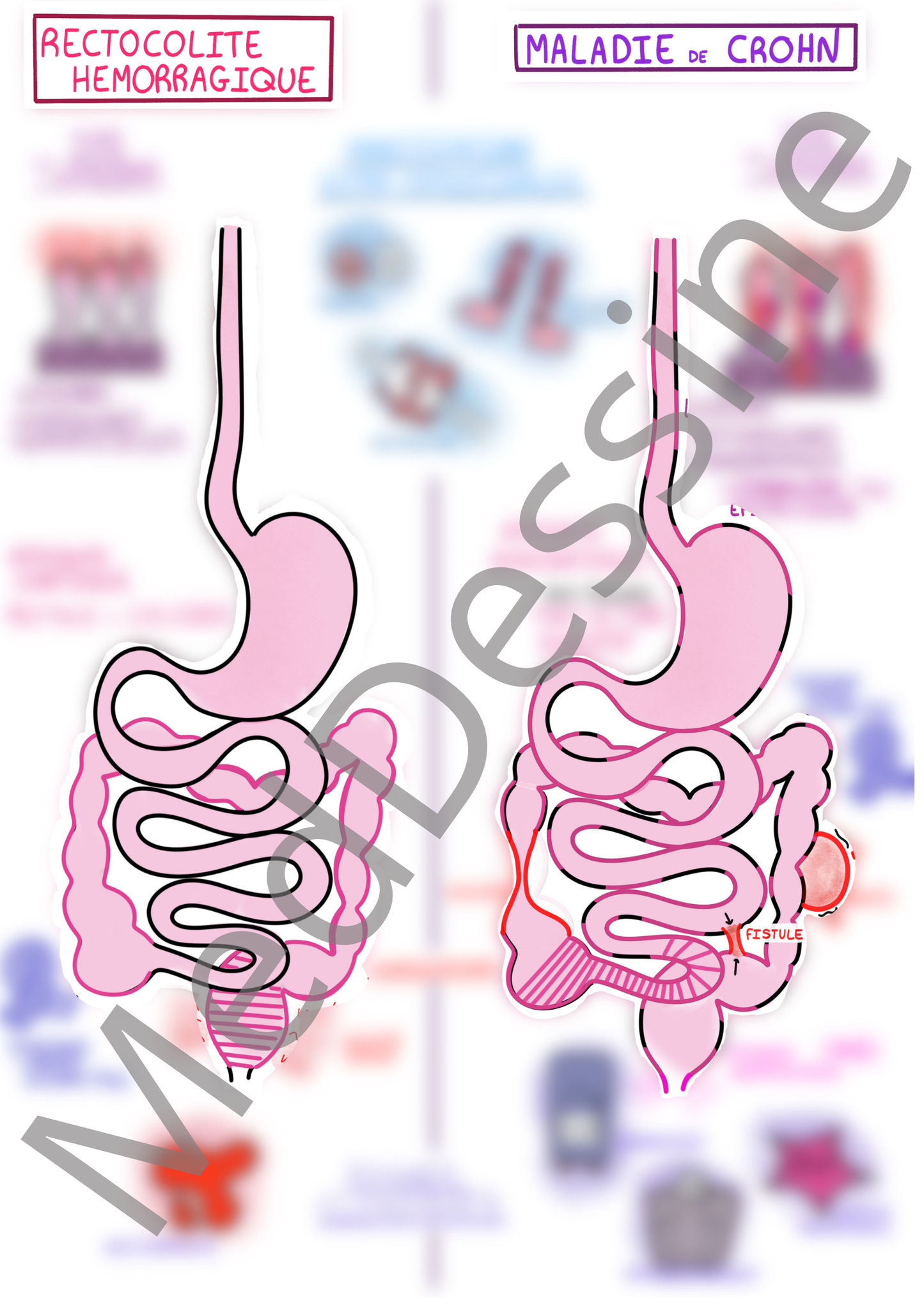 Les maladies inflammatoires chroniques de l'intestin (MICI)