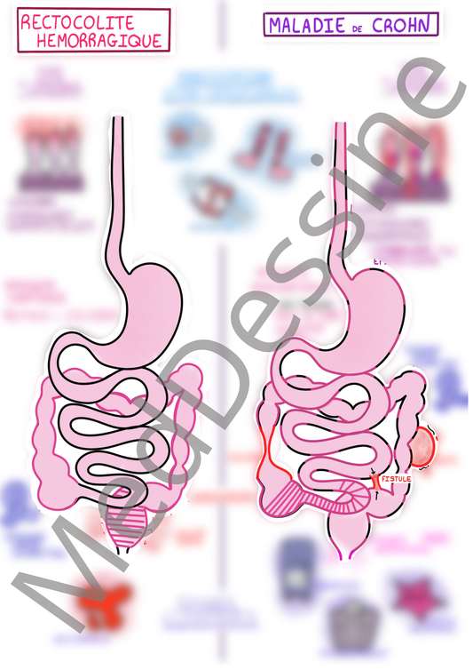 Les maladies inflammatoires chroniques de l'intestin (MICI)