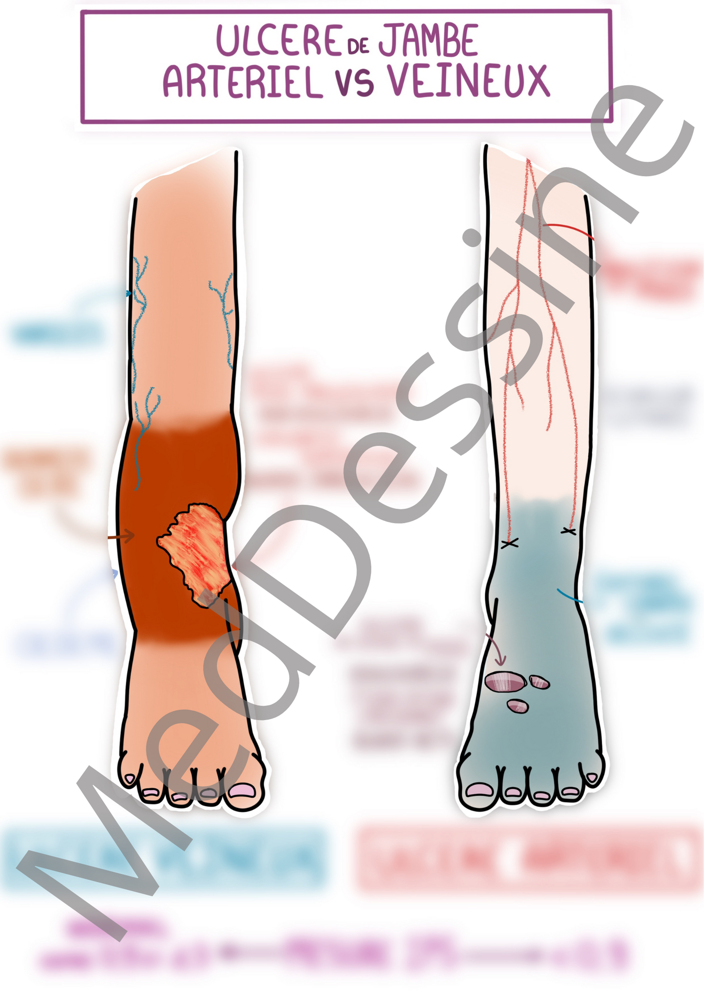 Ulcère de jambe ARTERIEL VS VEINEUX